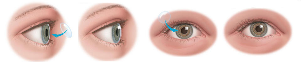 Keratoconus penetrating keratoplasty - corneal transplantation